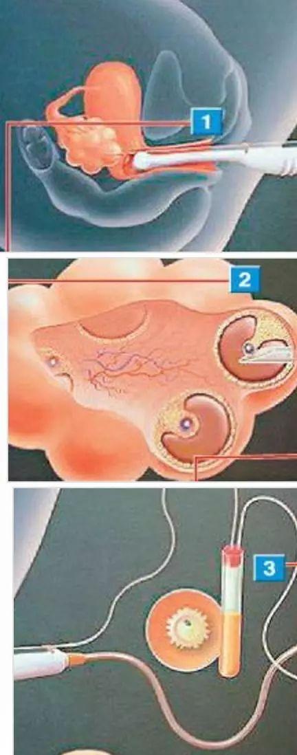 供卵的孩子跟母体有血缘关系吗【供卵孩子与母体是否有血缘关系?】